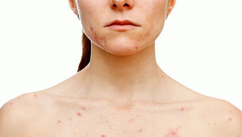 акне или угревая болезнь - распространённое кожное заболевание